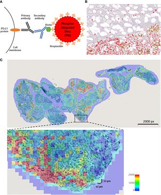 Novel quantitative immunohistochemical analysis for evaluating PD-L1 expression with phosphor-integrated dots for predicting the efficacy of patients with cancer treated with immune checkpoint inhibitors
